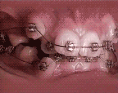 18+month+time+lapse+of+braces