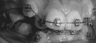 Braces+timelapse.