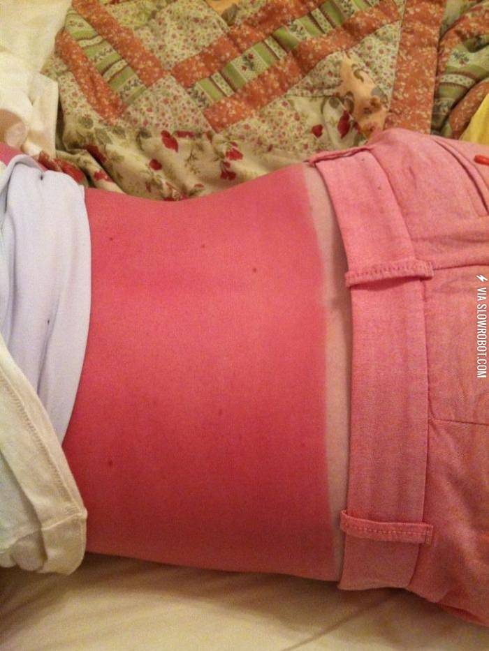 What happens when gingers go in the sun.