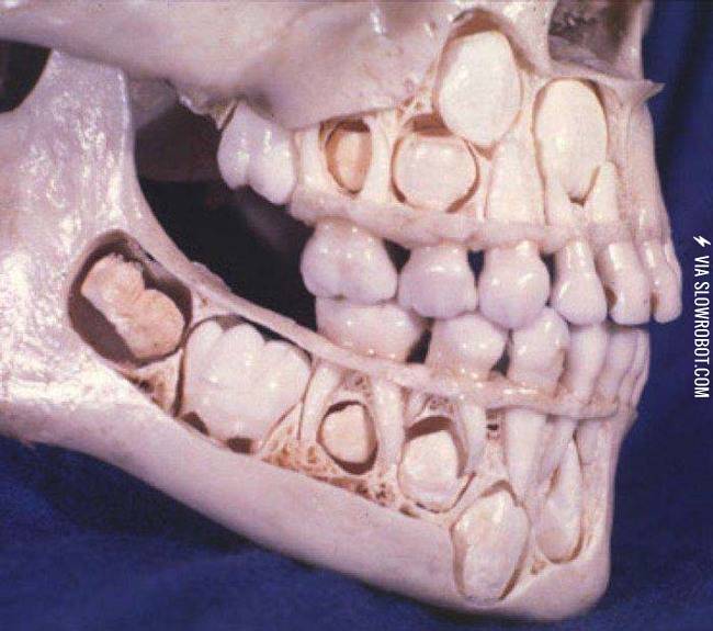The+inside+of+the+human+jaw+before+losing+any+baby+teeth.