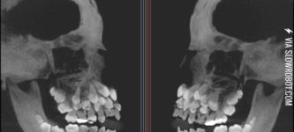 An+X-ray+of+someone+who+has+Multiple+Hyperdontia.