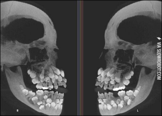 An+X-ray+of+someone+who+has+Multiple+Hyperdontia.