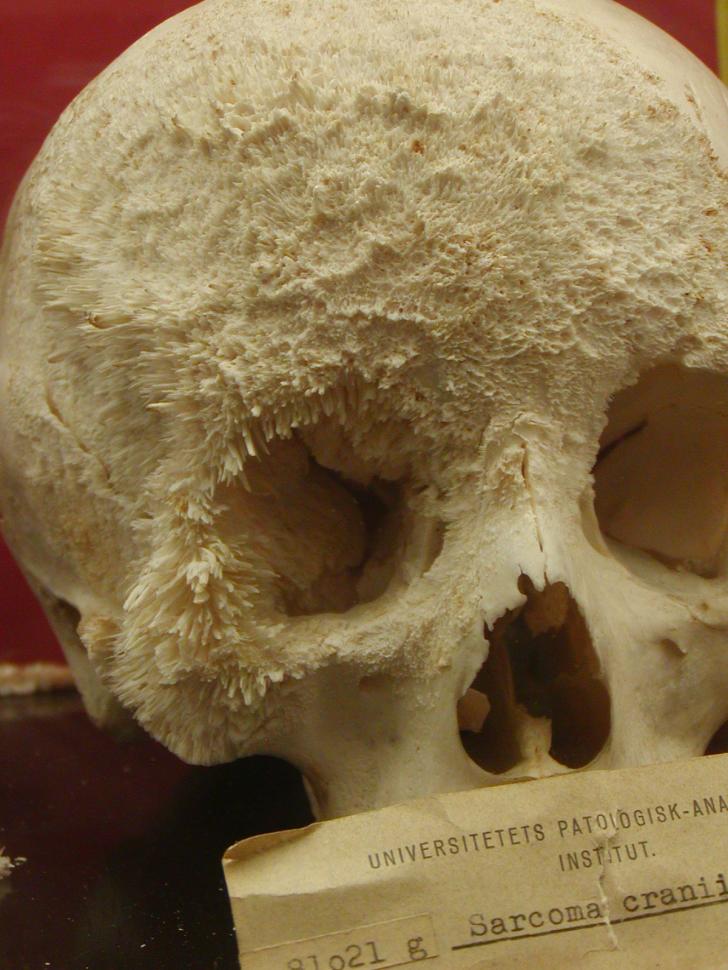 Bone+Cancer+Skull