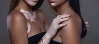 Vitiligo