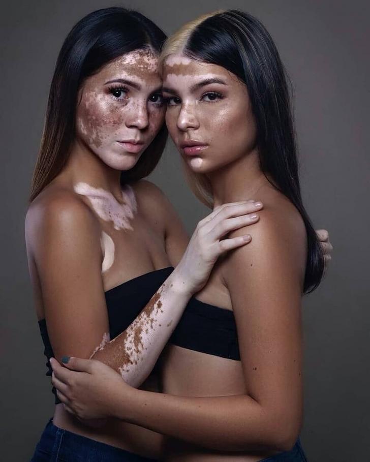 Vitiligo