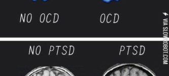 Brains+with+mental+disorders.