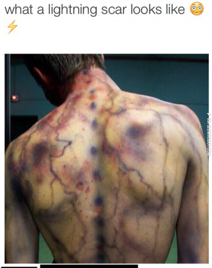 What+a+lightning+scar+looks+like.+OUCH.