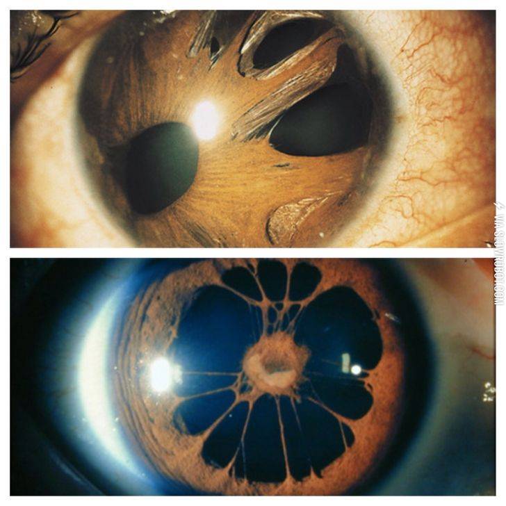 Polycoria+of+the+eye