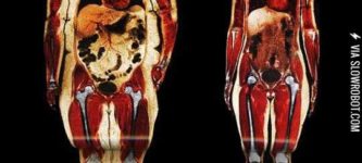 Body+scans.+Fat+vs.+thin.